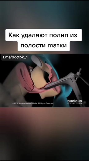 Удаление полипов: все, что нужно знать