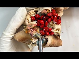 CUT Ingrown Toenails 👣 Toenails with Maggots, Fungal Toenails // Toenails N1009