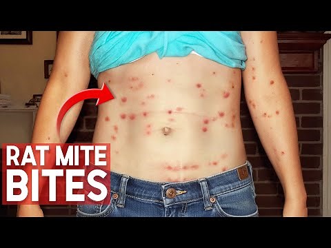 Rats Infested Her Home — and the Mites Were Biting Her!
