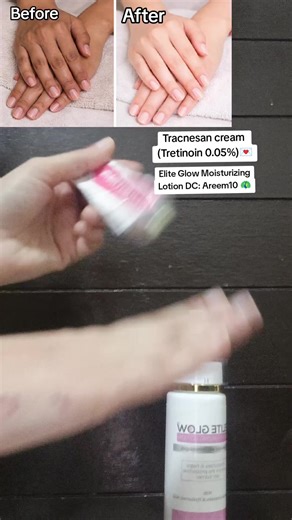 Use this twice a week for 15–20 minutes to help reduce darkness 💯 I’m using Tracnesan (Tretinoin) cream, which is easily available at any pharmacy. Along with it, I use @Elite Glow Hub Official Elite Glow Moisturizing Lotion (discount code Areem10). It contains hyaluronic acid, ceramides, glycerin, and panthenol to help prevent dryness over time. Wash your hands with Biore Extra Whitening Soap and apply Biore Sunblock in the daytime. Discount code: Areem10 is available on both. For orders 👉🏻 