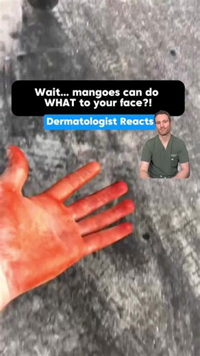 Dr. Taylor Bullock, MD | Dermatologist on Instagram: "Wait… 🥭 mangoes can do WHAT to your face?! 😳 Yes — mango peel and sap contain compounds similar to the one in 🌿 poison ivy. After a bad bout of poison ivy, you’re more likely to react to mangoes afterwards. It’s not the fruit itself — it’s the peel and sap near the stem that usually cause the rash! Mango = delicious AND dangerous. Also—mangos are probably my favorite fruit… Send this to your friend that loves mangos!"