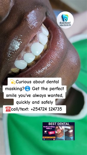 Transform Your Smile with Tooth Masking