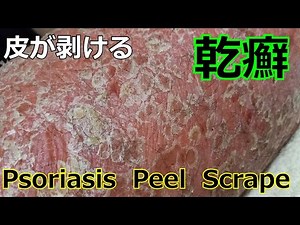 Endless Skin peeling 乾癬 [Psoriasis, Peel, Scrape] 银屑病 건선 Schuppenflechte Psoriasi かんせん【閲覧注意】
