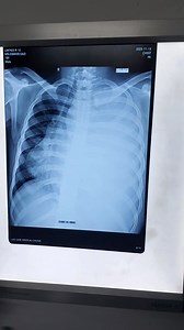 Sarcoma lung #viral #Bangladesh #fy #Cancer #indian #fashion #foryouシ #fypageシ #health #fy | Cancer Care by Dr.Salam