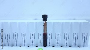 lab technician wearing a white lab coat and blue latex gloves placing a blood sample in a test tube in a vertical stand