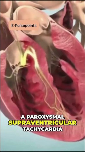 svt types #medicaleducation #nurse #doctorexplains