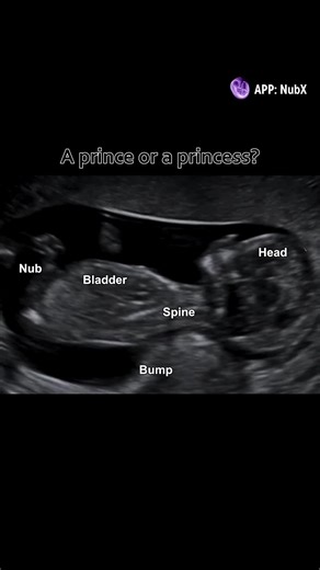 Understanding Baby Nub Theory for Gender Prediction