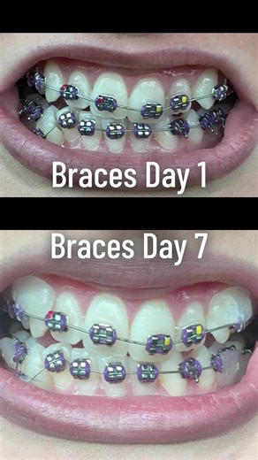 Some slight movement 🦷 #adultbraces #fyp #pain #braces #teeth | brace