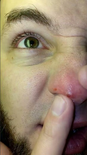 Ingrown nose hair out the front!