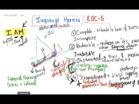 INGUINAL HERNIA MNEMONIC, and RING OCCLUSION made easy