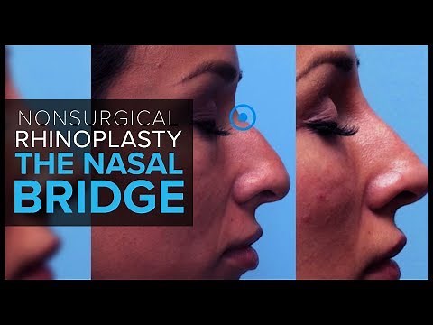 Non Surgical Rhinoplasty: Contouring the Nasal Bridge With Dermal Fillers at Mabrie Facial Institute