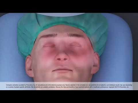 Animation of Thrombectomy Using a Stent