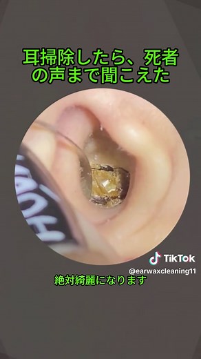 #耳垢ナカショー #耳垢掃除 #耳掃除 #earwaxremoval #earwax #satisfying