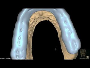 Exocad : Bite Splint Nightguard