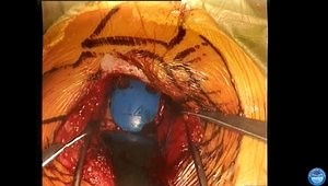 Subscapularis Sparing Total Shoulder Arthroplasty