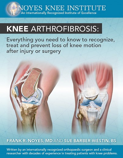 Knee Arthrofibrosis Center - The Noyes Knee Institute