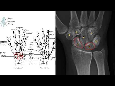 Carpal Injuries: Scaphoid Fracture, Carpal Dislocations and wrist sprain.