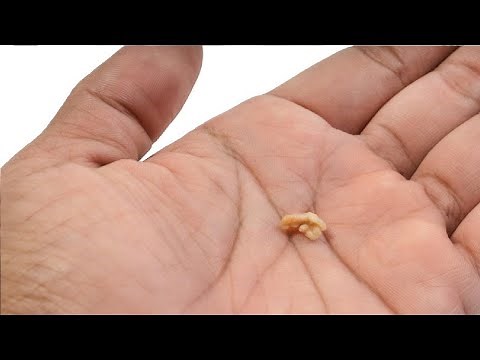 how to get rid of tonsil stones deep in the throat