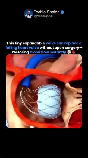 How Doctors Replace a Heart Valve Without Open Surgery | TAVR Procedure Explained 🤯🫀