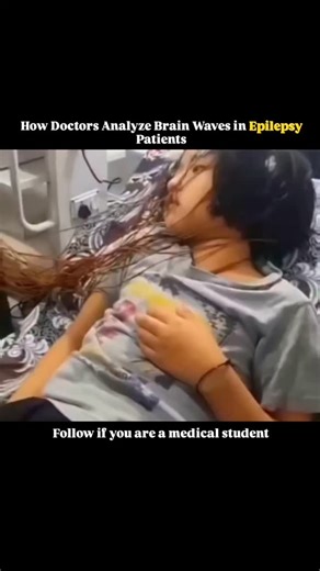 @medicalstudent.io on Instagram: "Doctors analyze brain waves in epilepsy patients by recording the brain’s electrical activity using electroencephalography, or EEG, a noninvasive test that places small electrodes on the scalp to detect abnormal patterns. During analysis, neurologists look for irregular spikes, sharp waves, or unusual rhythms that signal areas of the brain where seizures may originate. These recordings are often taken during rest, sleep, or after specific triggers such as flashi