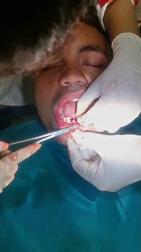 Radicular cyst irt 41–33 treated with extraction, curettage & RCT 🦷✨ #OralSurgery”