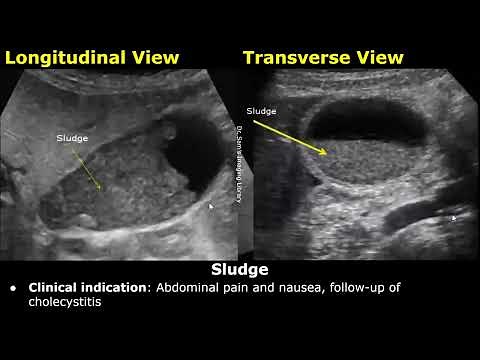 Gallbladder Ultrasound Reporting | GB Disease Scan Reports | How To Write USG Report | Abdominal USG