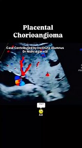 #drrandhawainstitute #chorioangioma #onlineultrasoundtrainingfordoctors #ultrasoundvideos #POCUS #sonologist #bestultrasoundtraining | Dr.Randhawa’s Institute of Ultrasound Training ,Delhi -Affiliate Jurei,USA