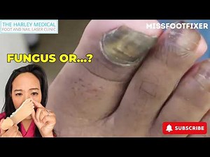Severely Damaged Nail Removal – Is It Fungus Underneath? by Miss Foot Fixer Marion Yau