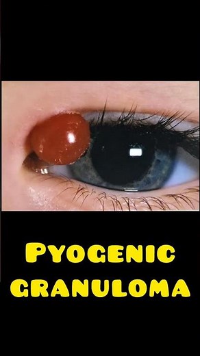 “This Eye Bump | Pyogenic Granuloma” #ophthalmology #eyes #optometry