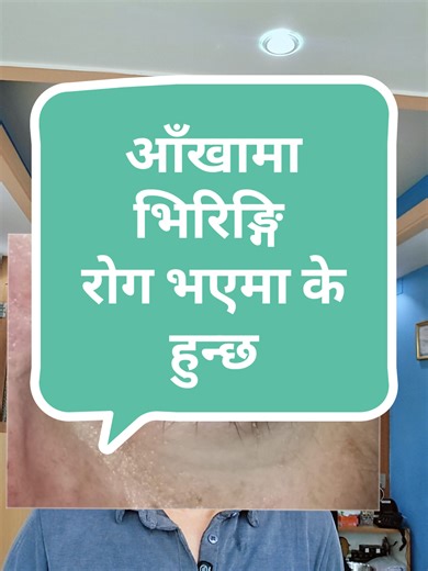 Ocular Syphilis Symptoms in Nepali Eyes | Dr. Kamal Raj Dhital