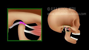 Temporomandibular Joint (TMJ) Anatomy and Disc Displacement Animation