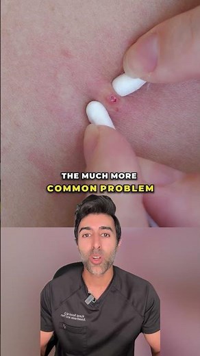 Do Not Pop a Pimple Here