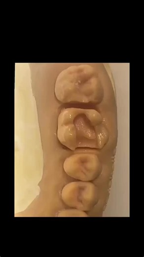 Beyond just filling a tooth 🚀 A circumferential matrix band is key to rebuilding proper tooth anatomy. It helps restore the gingival seat and achieve a tight proximal contact, preventing food traps and future issues. Think of it as a temporary wall for a perfect composite seal and shape. #DentalEducation #DentalStudent #fyp #Dentistry | TheMedcz