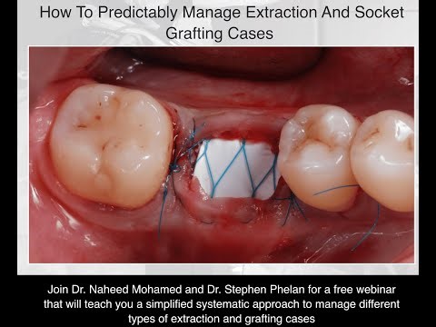 How To Predictably Manage Extraction and Socket Grafting Cases
