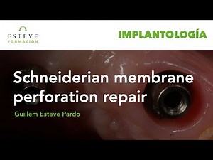 Schneiderian Membrane perforation repair - Reparación de perforación de membrana de Schneider.