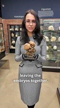 What are Conjoined Twins?