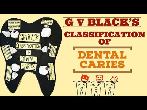 Classification of Dental Caries| GV Black's Classification | Model for PHD #dental