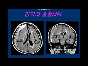경막하 출혈MRI