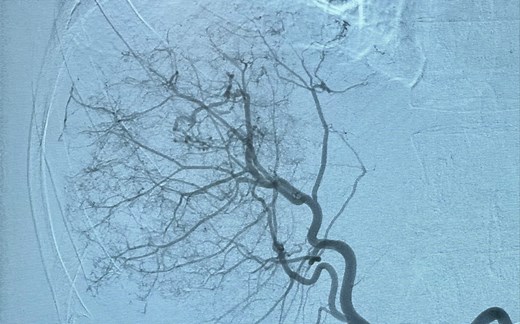 肝癌的TACE到底是什么？一个视频搞懂