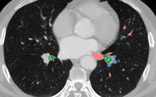 《肺段学习汇》-左肺上叶case 1 part1二维CT解读肺段解剖