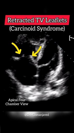 Retracted Leaflets of Tricuspid Valve seen in a patient of Carcinoid Syndrome #heart #echo