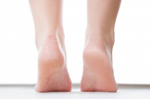 7 Possible Reasons for Peeling Feet