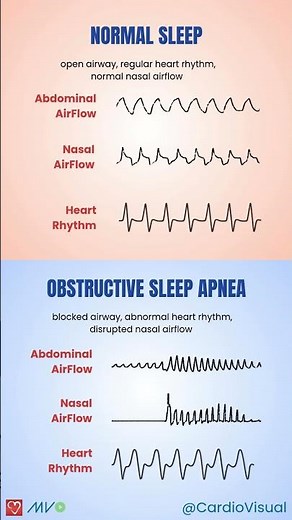 How Sleep Apnea Disrupts the Heart 💤