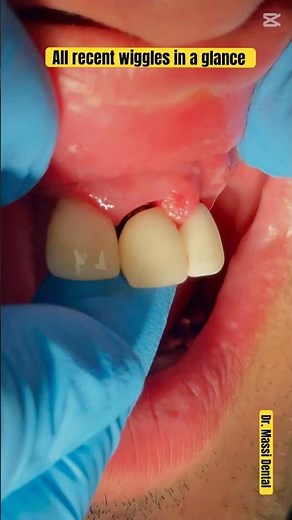 Wiggly Teeth ?! What’s going on !!