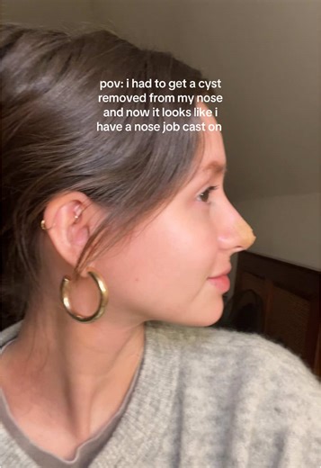 Cyst Removal Aftermath: My Nose Job Experience