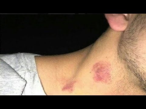 GET RID OF A HICKEY YOU ONLY NEED A FEW MINUTES