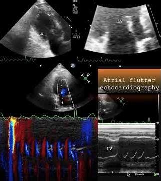 Atrial flutter/ echocardiography