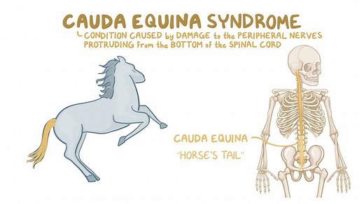Video: Cauda equina syndrome - Video Explanation! | Osmosis | Osmosis