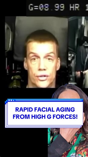 This is what gravity actually does to your face over time! These fighter pilot G force simulation videos are fascinating examples of facial aging. With 9x earth’s gravity pulling on the face, you’ll see that the midface drops, the lower eyelids sag, fat pockets hollow out, and temples lose volume. It's the same process that happens to all of us over years and decades, just sped up. This is exactly why facial rejuvenation procedures focus on restoring what gravity has taken. Understanding the