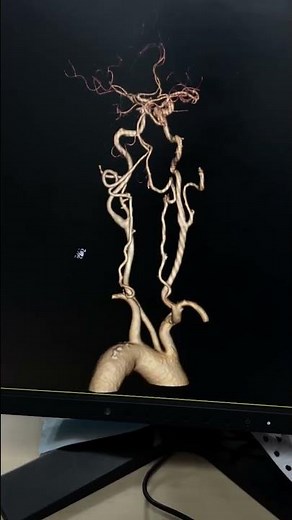 Ct Angiography Neck And Brain /3D Reconstruction of Angio Neck and Brain